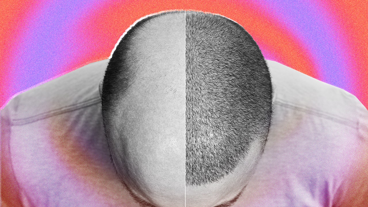 What a Hair Transplant Looks Like—Week By Week